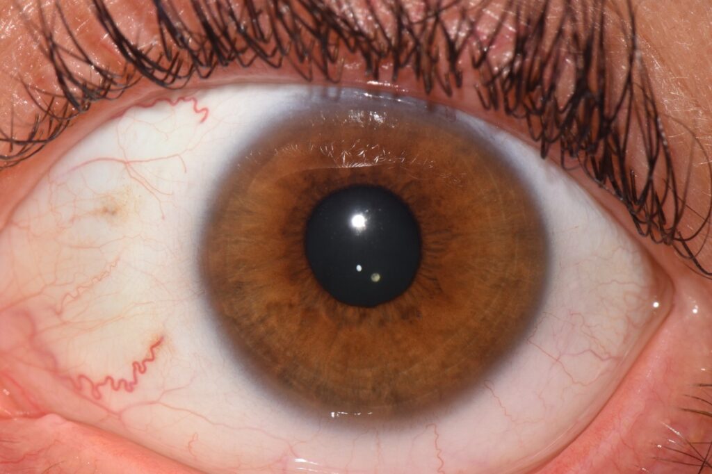 Biliary Mixed Iris Eyes (Brown and Blue) | Iridology by Peppy | Peppy Caccavale | Las Vegas, Nevada