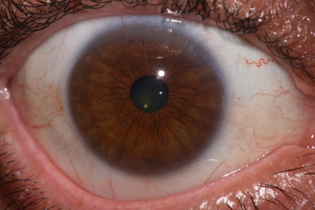 Hematogenic Brown Iris Eyes | Iridology by Peppy | Peppy Caccavale | Las Vegas, Nevada