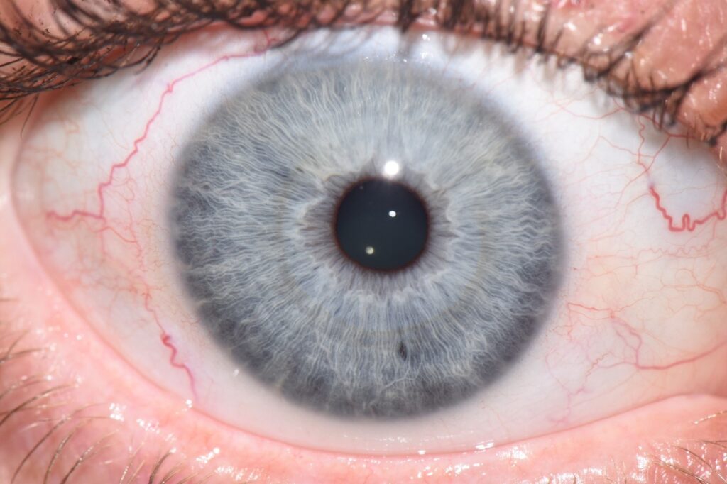 Lymphatic Blue Iris Eyes | Iridology by Peppy | Peppy Caccavale | Las Vegas, Nevada